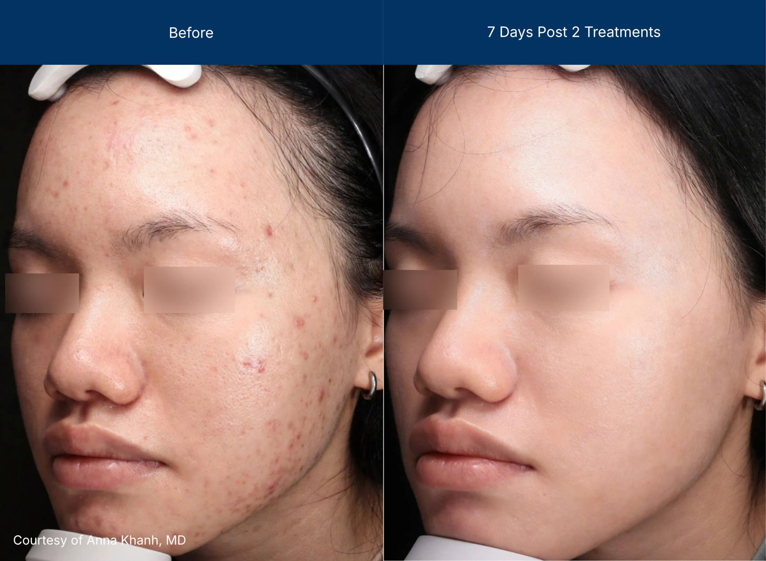 ultraclear before-after