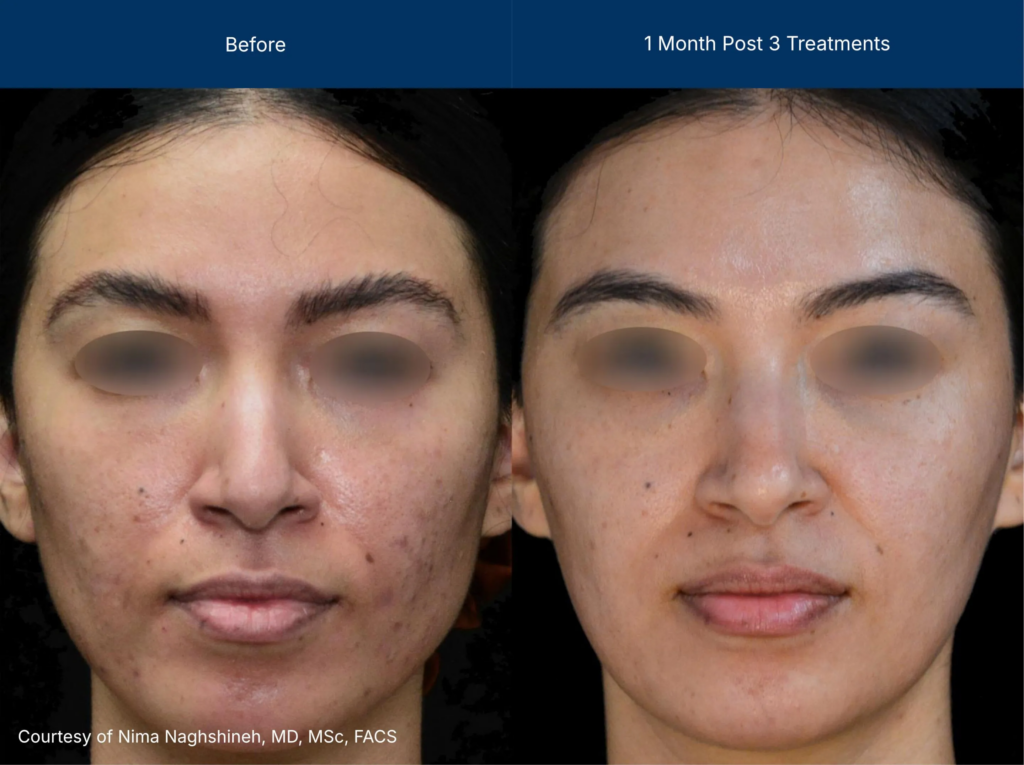ultraclear before after