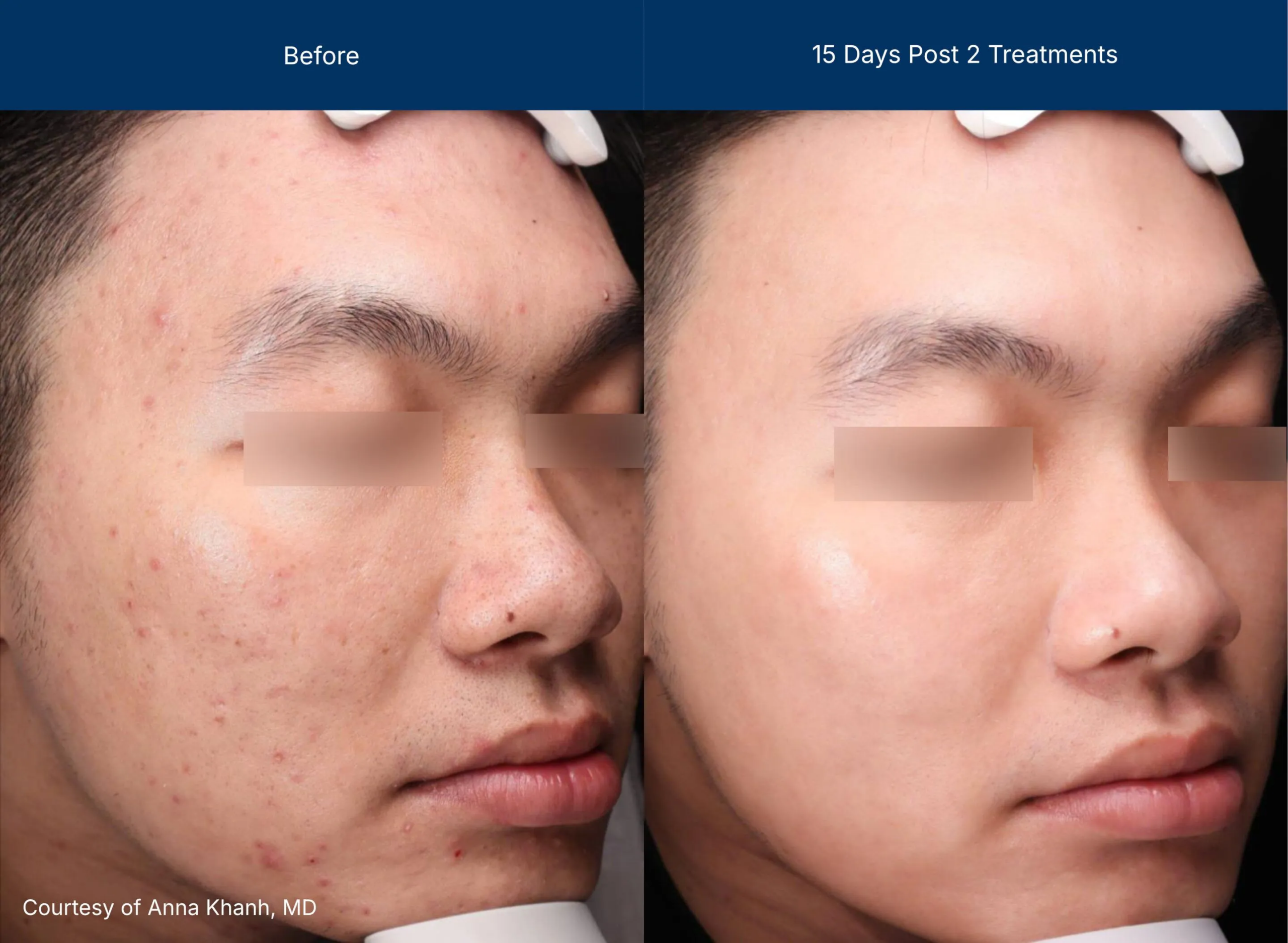 ultraclear before-after